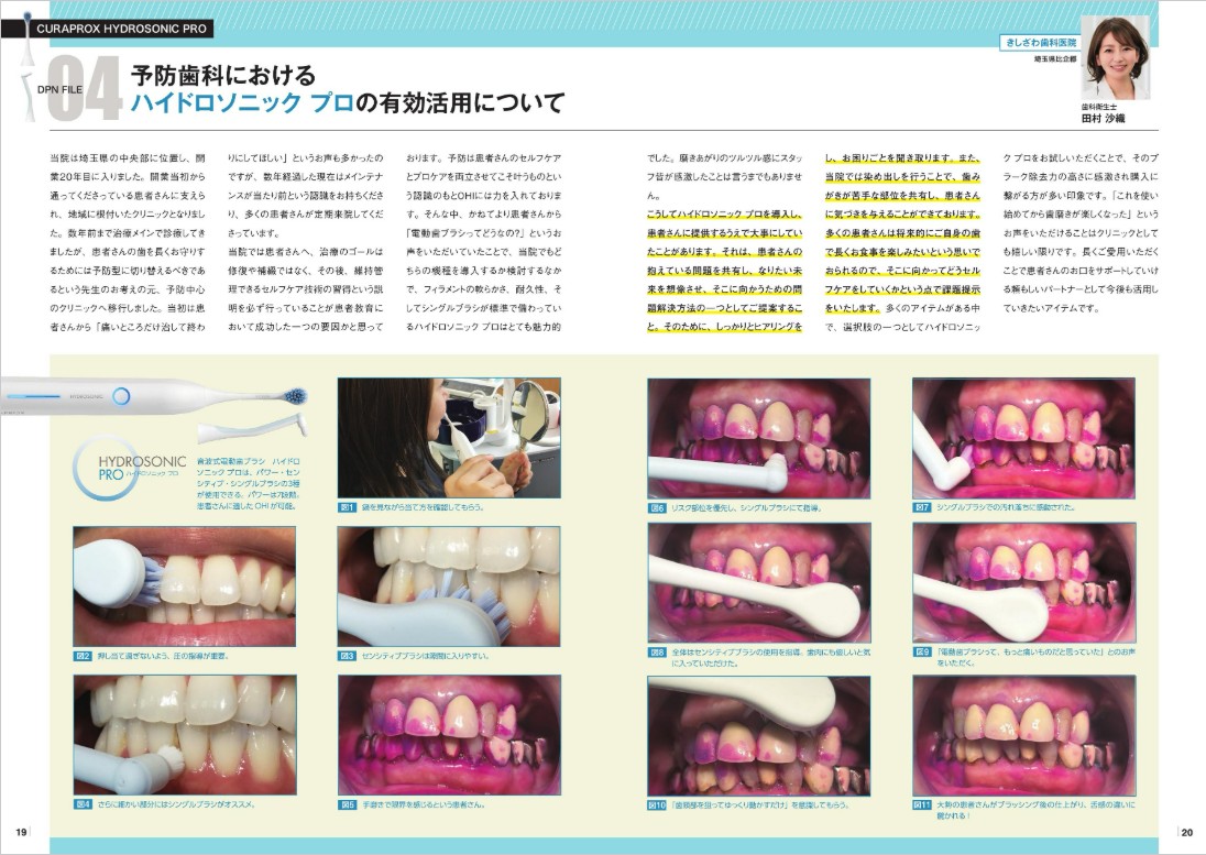 予防歯科におけるハイドロソニックプロの有効活用について