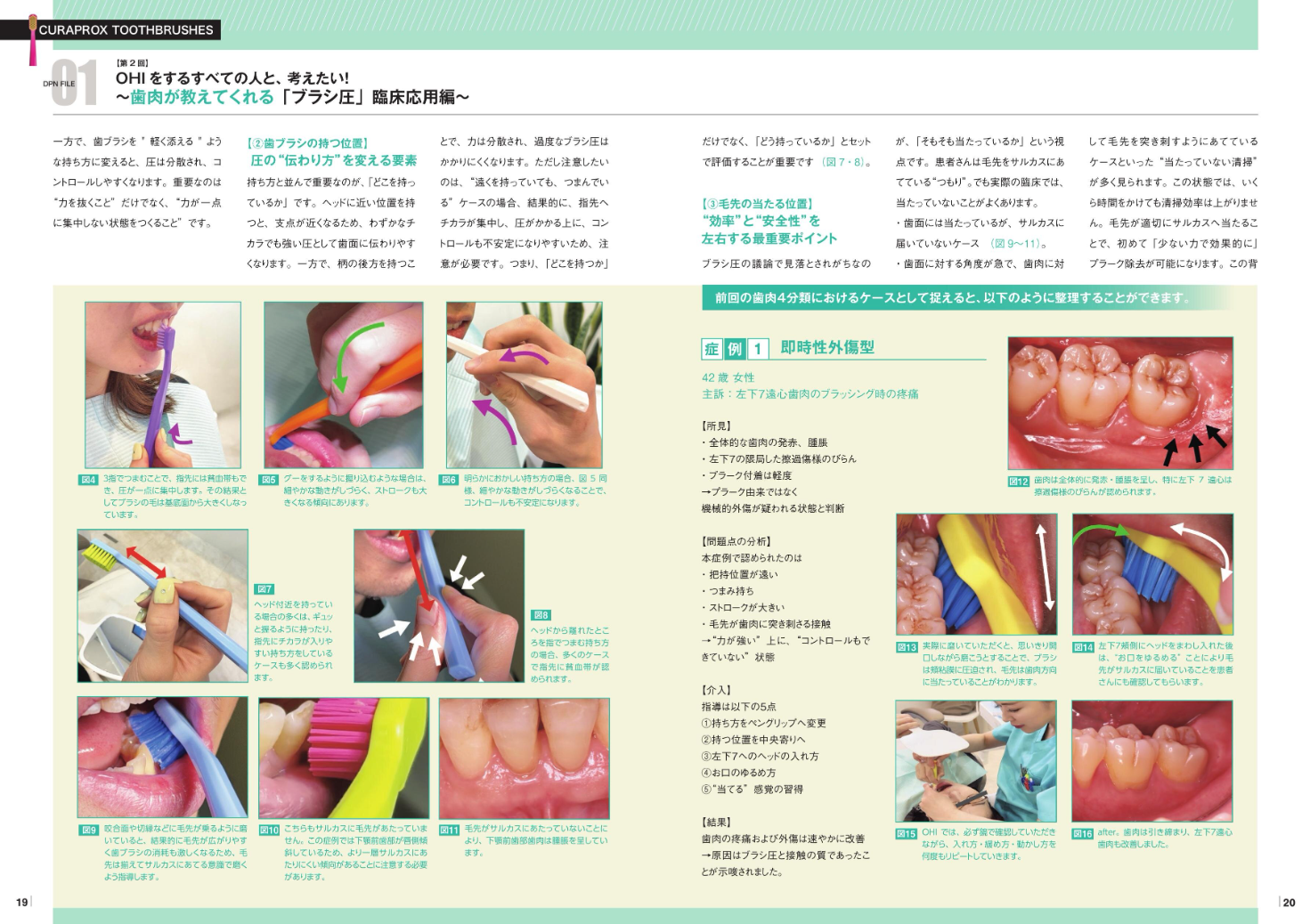 OHIをするすべての人と、考えたい！～歯肉が教えてくれる「ブラシ圧」臨床応用編～